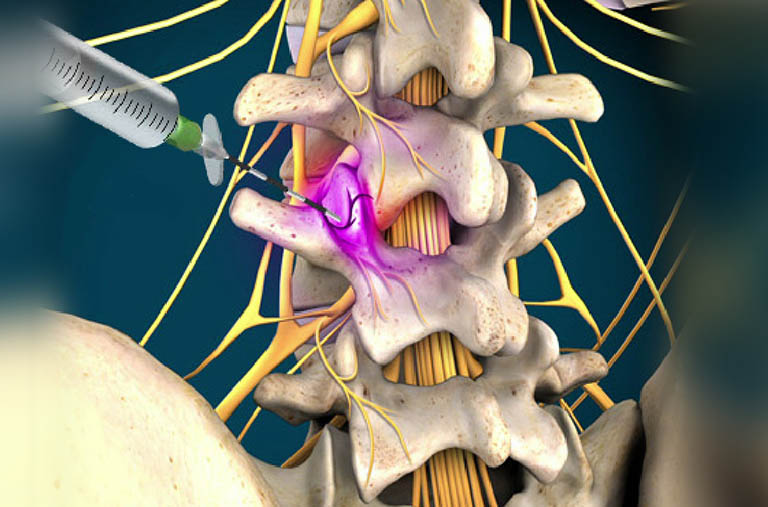 Tiêm ngoài màng cứng điều trị đau và viêm do thoát vị đĩa đệm