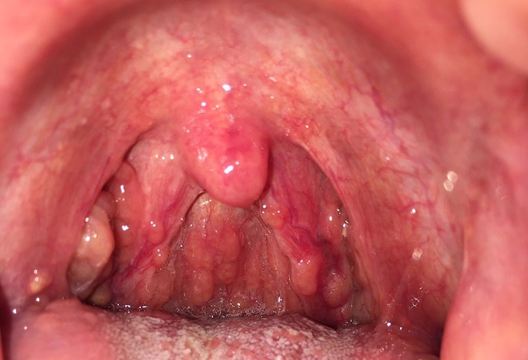 Viêm họng mạn tính quá phát còn có tên gọi khác là viêm họng hạt