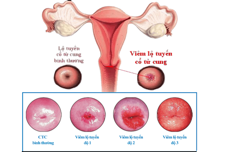 Viêm lộ tuyến độ 2 