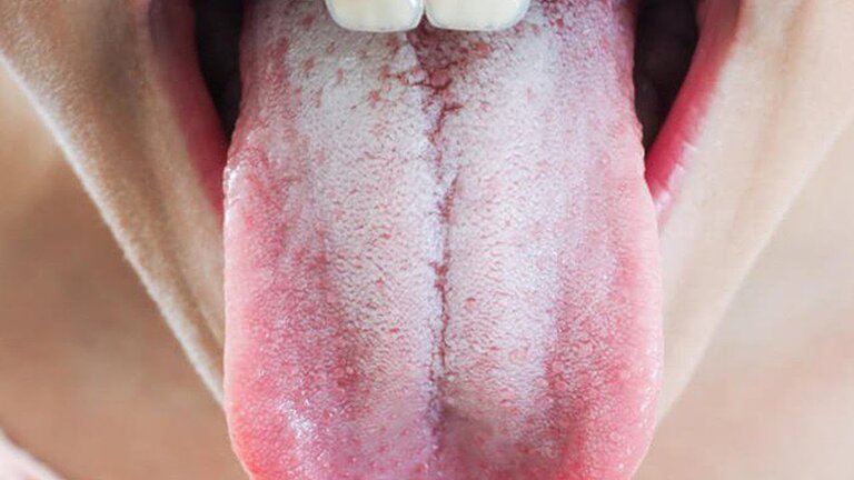 Lưỡi trắng có mùi hôi là nguyên nhân do đâu?
