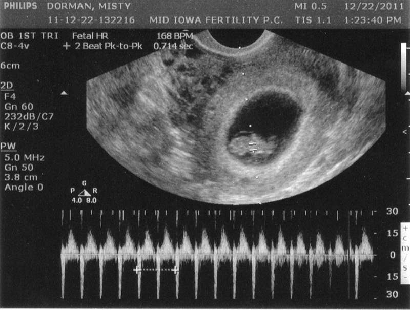 Hình ảnh siêu âm thai nhi