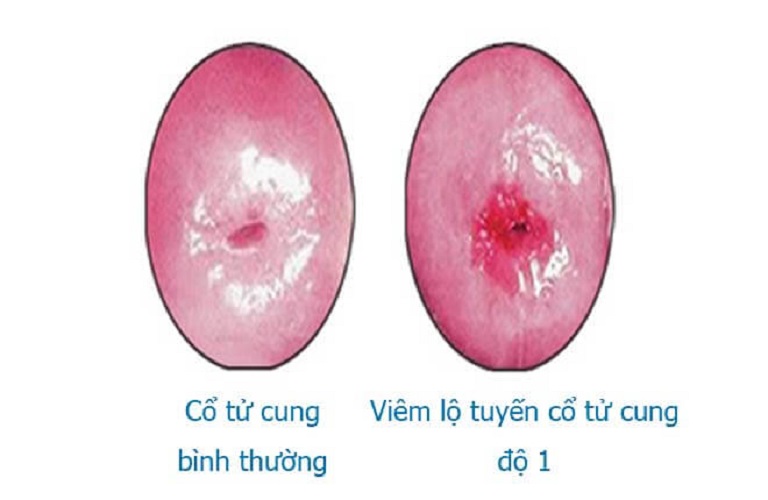 Viêm độ tuyến 5mm là thuộc cấp độ 1