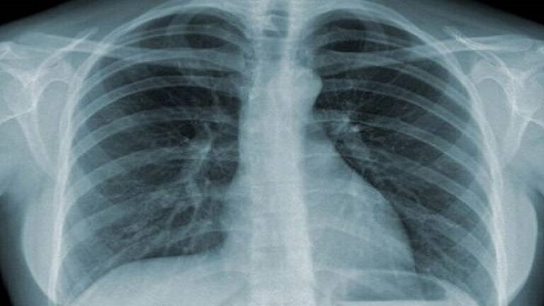 Hình ảnh chụp Xquang giúp phát hiện những bất thường ở tim và phổi