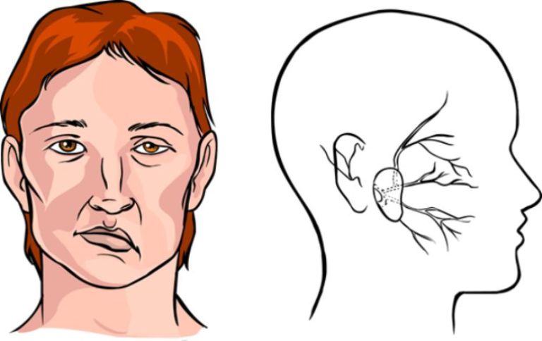 Liệt mặt là biến chứng thường thấy của viêm mũi xoang xuất tiết