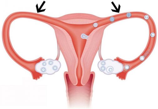 Tắc vòi trứng có thể gây ra vô sinh hiếm muộn ở chị em