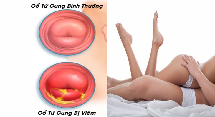 Viêm cổ tử cung có quan hệ được không