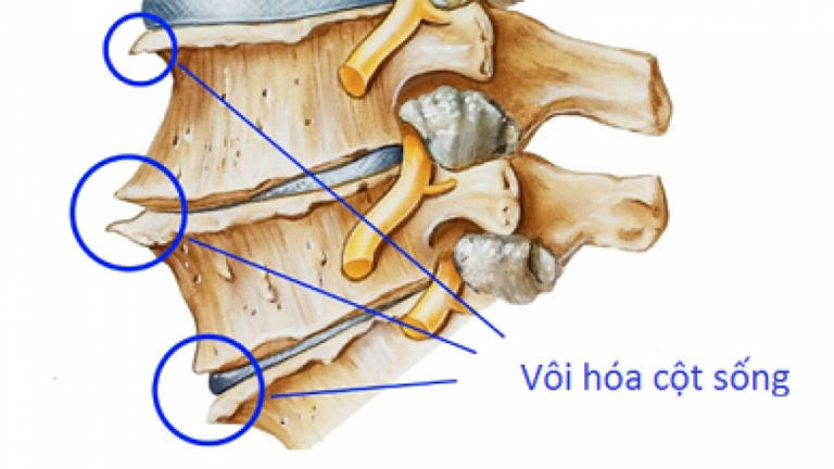 Vôi hóa cột sống thường hình thành mấu gai