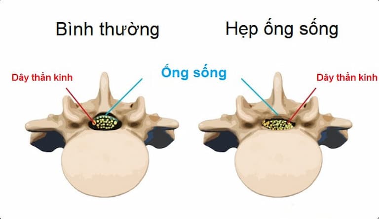 Hẹp ống sống