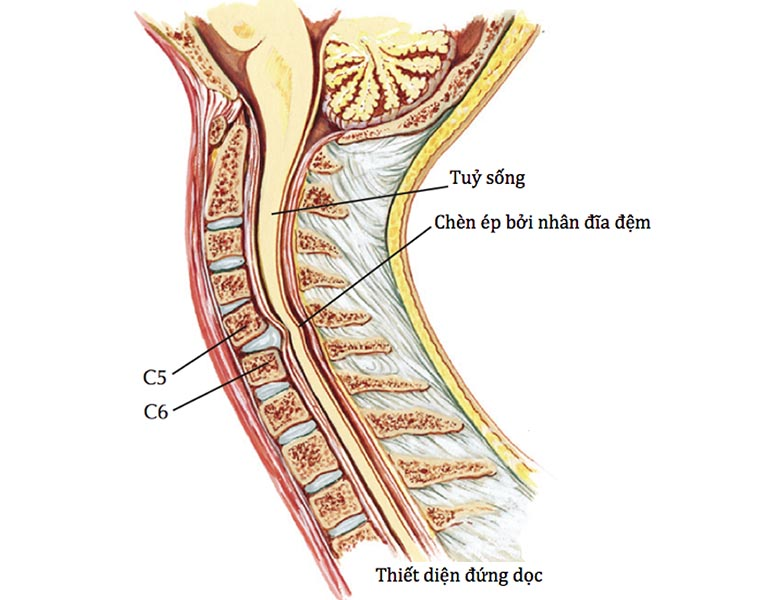 Hình ảnh thoát vị đĩa đệm đốt sống cổ