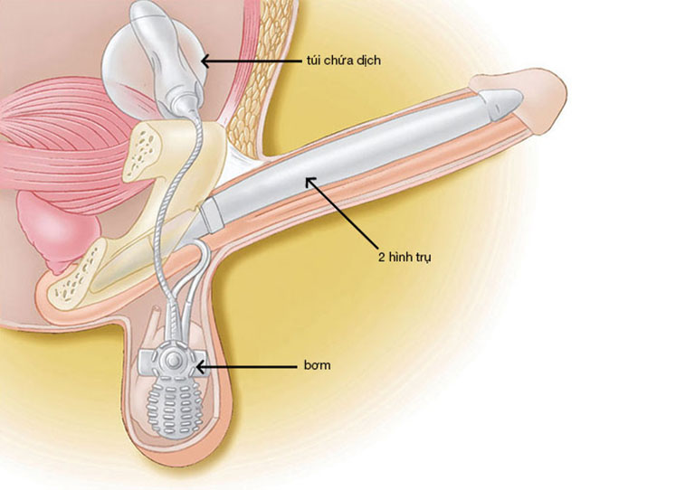 Lựa chọn vật liệu phẫu thuật chữa liệt dương