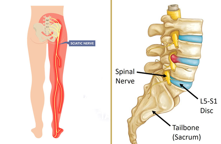 Đau thần kinh tọa và thoát vị đĩa đệm