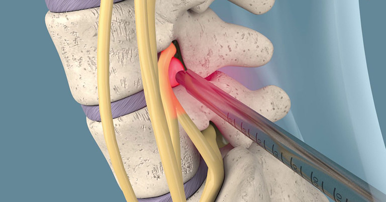 Mổ nội soi thoát vị đĩa đệm