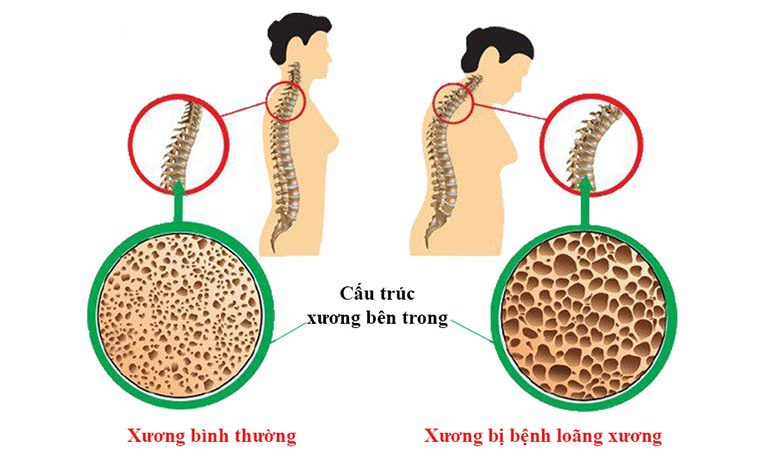 Mổ thay đĩa đệm nhân tạo có nguy hiểm không