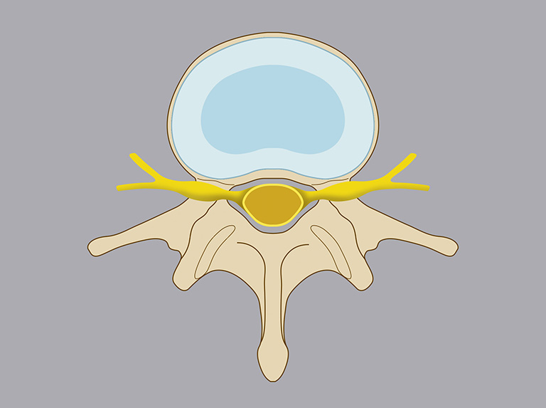 Thoát vị đĩa đệm chèn dây thần kinh