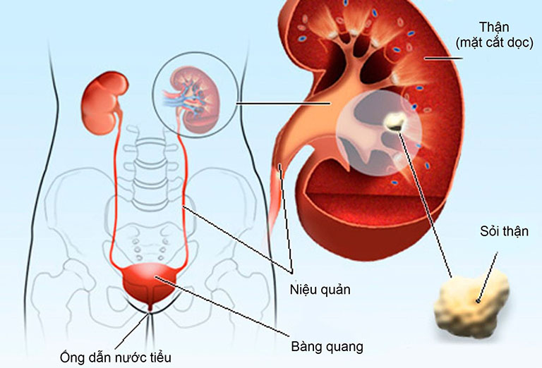 Suy thận cấp sau thận thường gặp ở những bệnh nhân bị sỏi thận