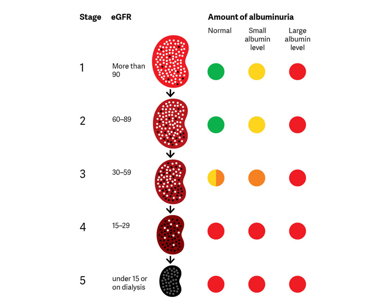 Bệnh thận mãn tính được chia thành 5 giai đoạn