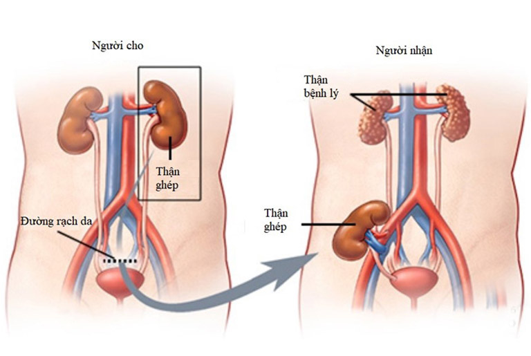 Ghép thận