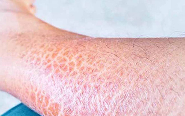 Bệnh Da Rắn: Nguyên Nhân, Triệu Chứng và Điều Trị