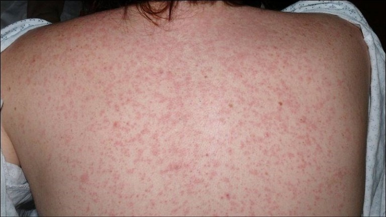 Điều trị bệnh phát ban bằng Y học cổ truyền