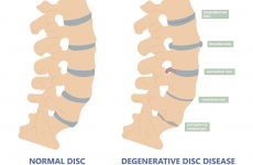 Thoái hóa cột sống