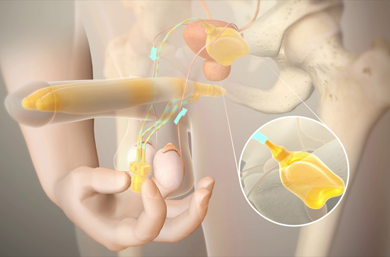 Phẫu thuật chữa liệt dương được xem xét khi các phương pháp điều trị khác không hiệu quả