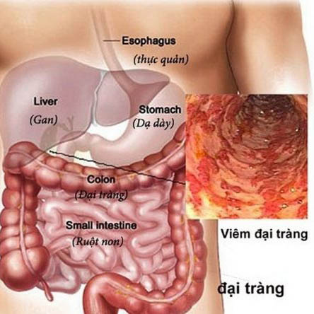 Điều trị bệnh đại tràng bằng y học cổ truyền