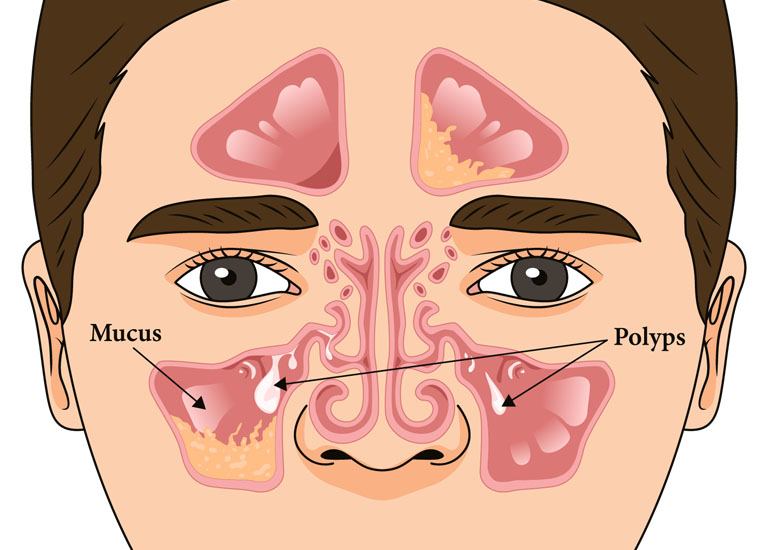 Polyp mũi hoặc xoang có thể chặn dòng chảy của dịch từ các xoang và viêm