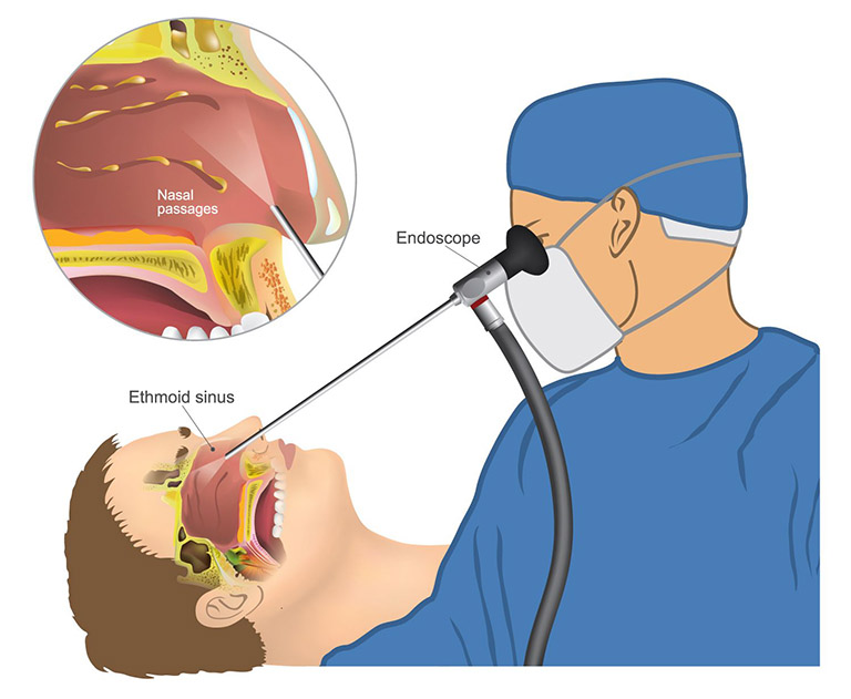 Phẫu thuật khi điều trị không hiệu quả hoặc có vấn đề cấu trúc mũi cần được chỉnh sửa