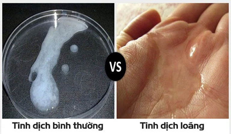 Tinh trùng loãng có màu trong như nước lã