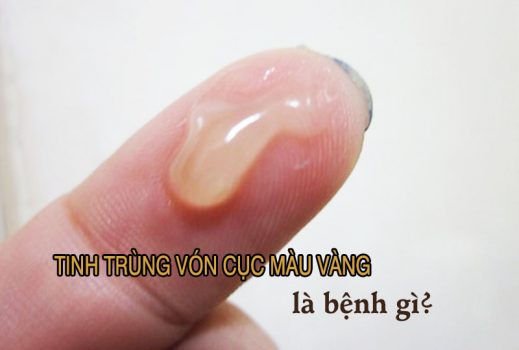 Tinh trùng vón cục màu vàng