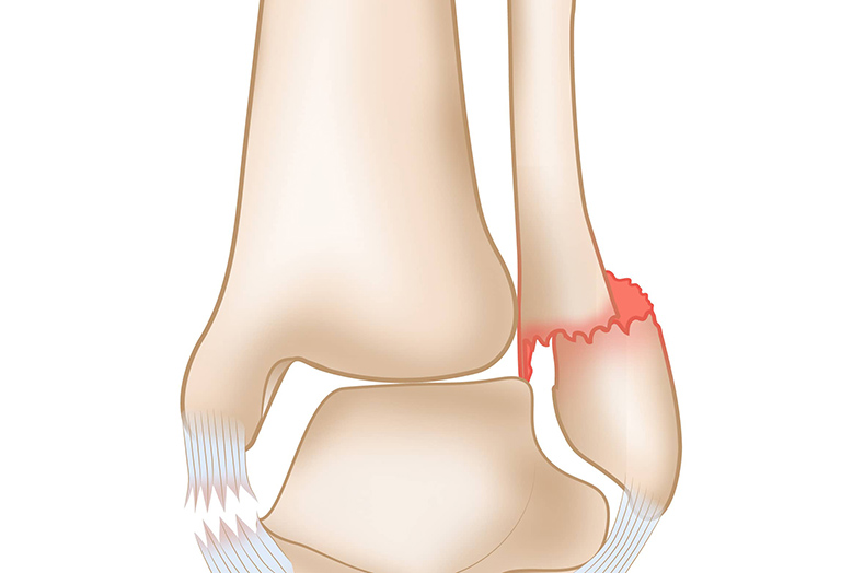 Gãy mắt cá chân