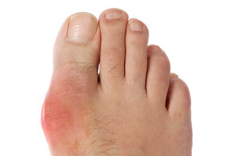 Đau nhức người sau khi uống bia rượu do bệnh gout