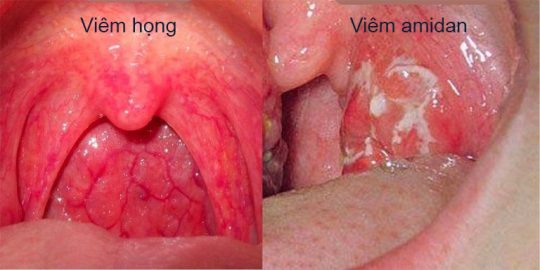 phan-biet-viem-hong-va-viem-amidan-2