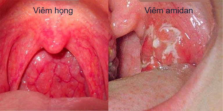 phân biệt viêm họng và viêm amidan