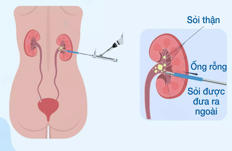 Chăm sóc bệnh nhân tán sỏi qua da