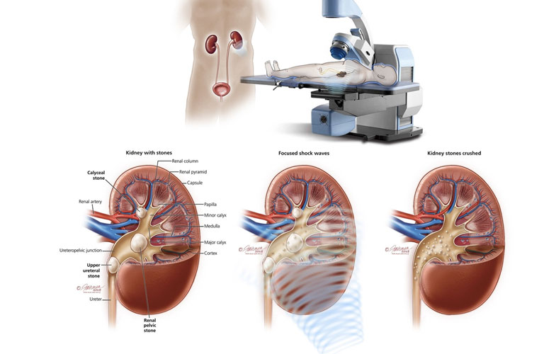 Tán sỏi niệu quản ngoài cơ thể