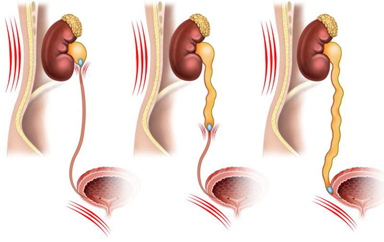 Sỏi niệu quản 