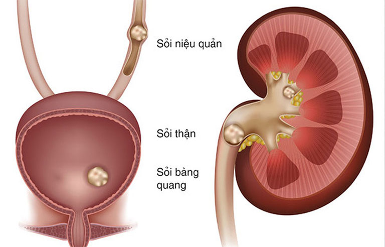 nguyên nhân gây sỏi niệu quản