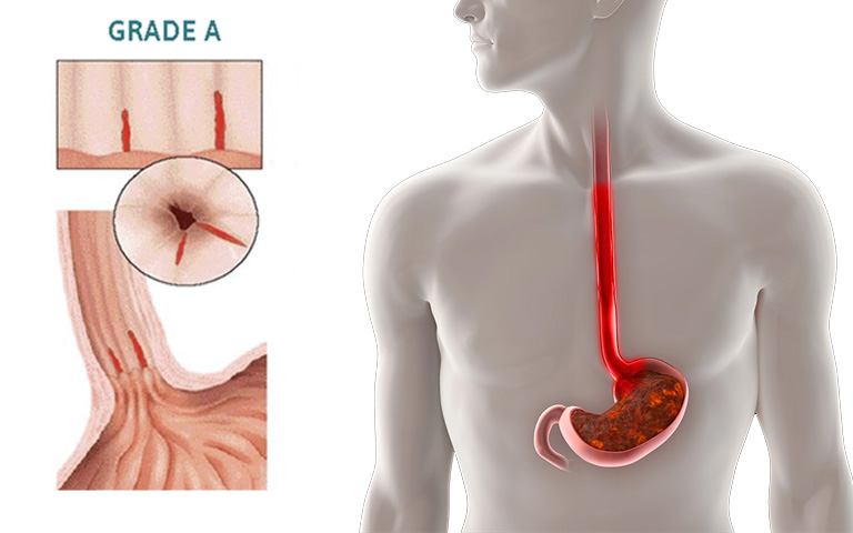 trào ngược dạ dày độ a là gì