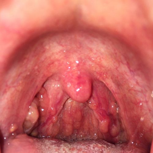 Điều trị viêm họng hạt bằng y học cổ truyền (YHCT)