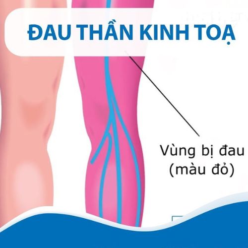 Đau thần kinh tọa theo quan niệm Y học cổ truyền