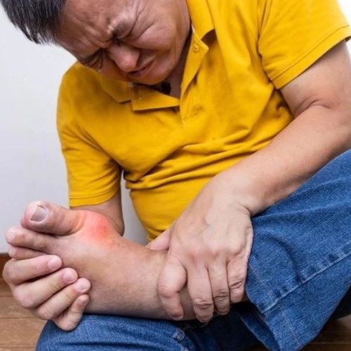 Gout theo góc nhìn của y học cổ truyền