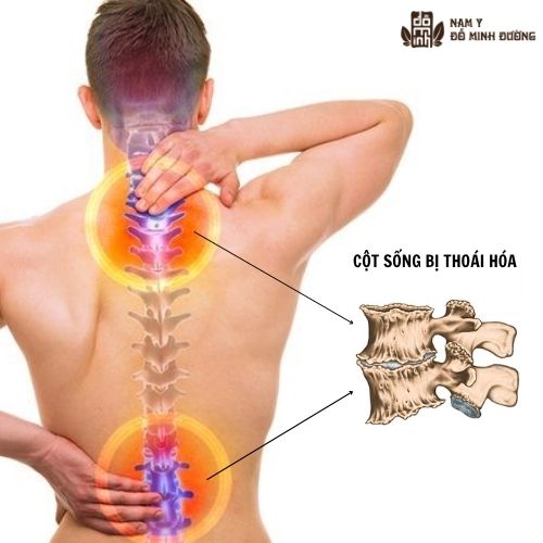 Thoái hóa cột sống theo quan niệm Y học cổ truyền