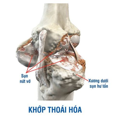 Điều trị bệnh thoái hóa khớp bằng YHCT