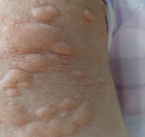 ĐIỀU TRỊ MỀ ĐAY BẰNG Y HỌC CỔ TRUYỀN