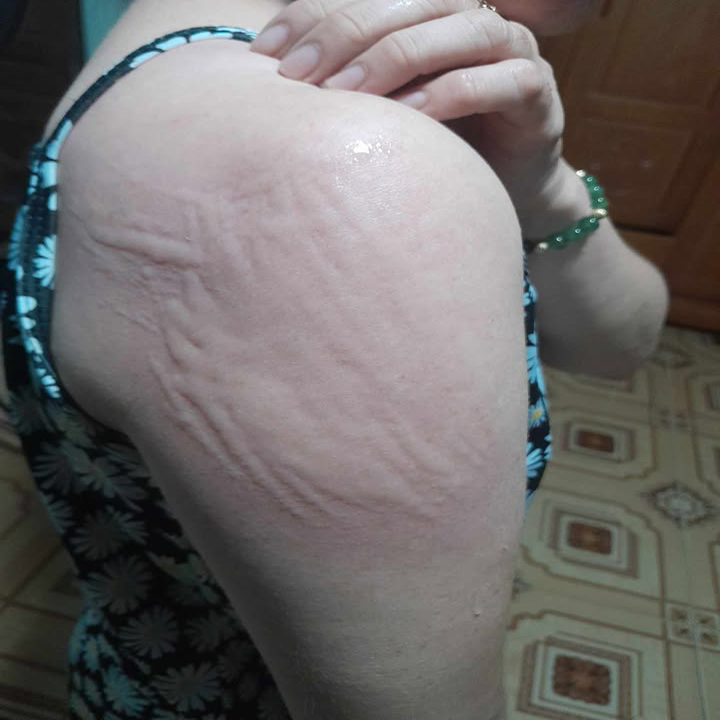 Điều trị bệnh phát ban bằng Y học cổ truyền