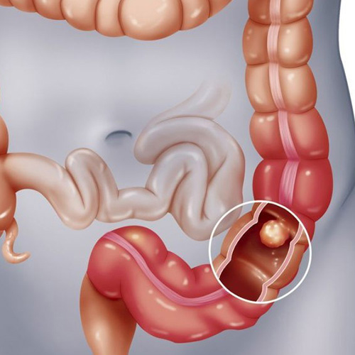 Điều trị bệnh đại tràng bằng y học cổ truyền