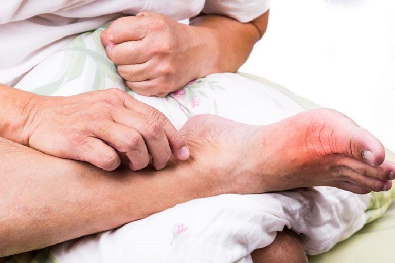 chu-dung-bi-gout.jpg
